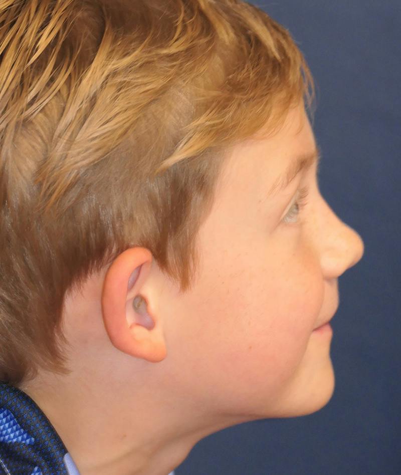 Ear Pinning (Otoplasty) Before & After Gallery - Patient 538315 - Image 3