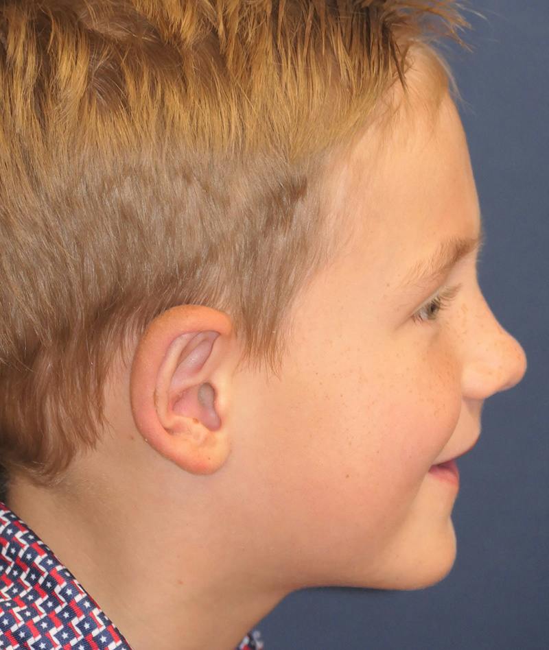 Ear Pinning (Otoplasty) Before & After Gallery - Patient 538315 - Image 4