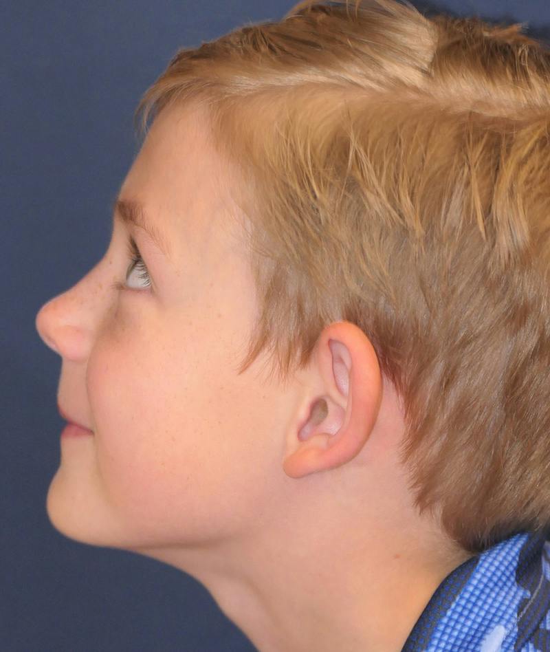 Ear Pinning (Otoplasty) Before & After Gallery - Patient 538315 - Image 7