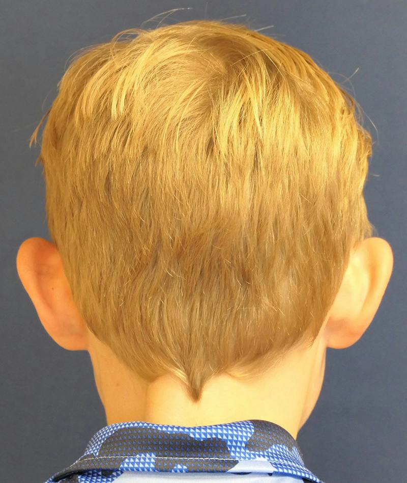 Ear Pinning (Otoplasty) Before & After Gallery - Patient 538315 - Image 5