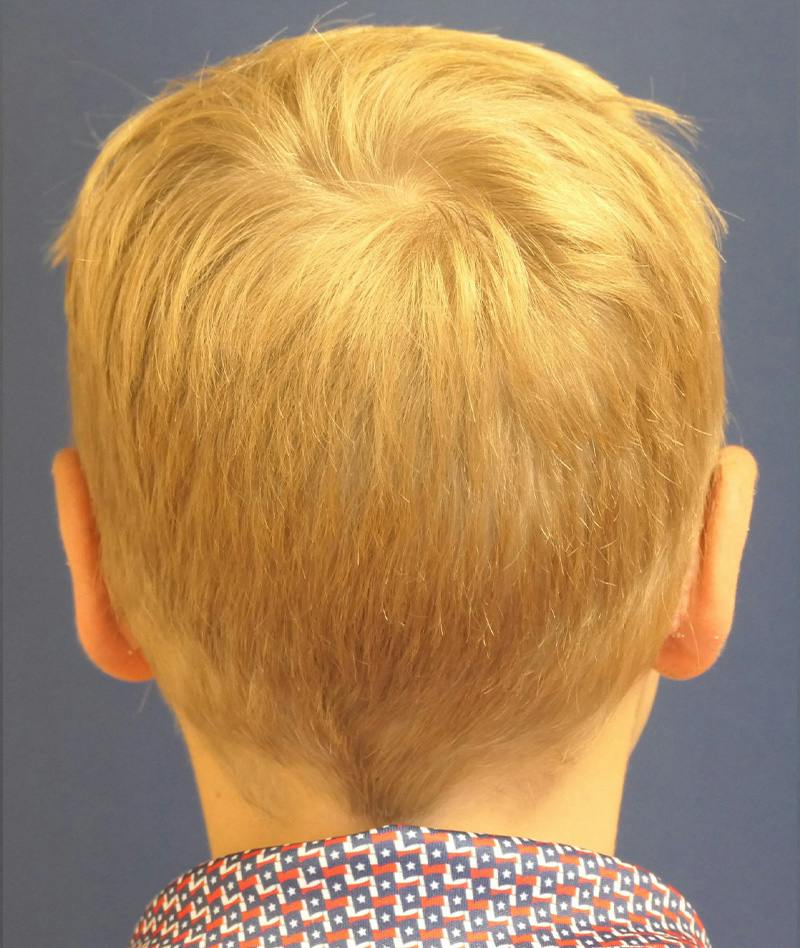Ear Pinning (Otoplasty) Before & After Gallery - Patient 538315 - Image 6