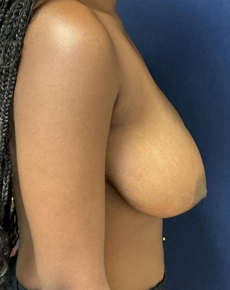 Breast Lift Before & After Gallery - Patient 312744 - Image 5