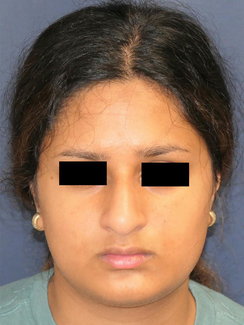 Rhinoplasty Before & After Gallery - Patient 890061 - Image 5