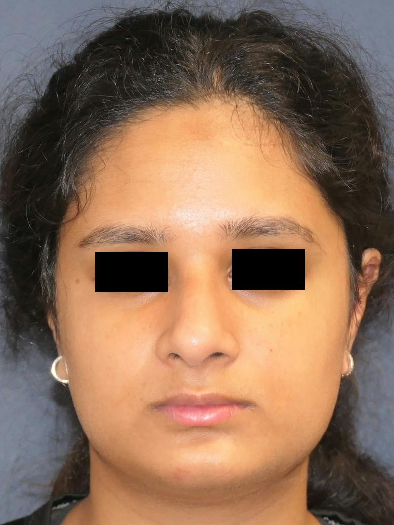 Rhinoplasty Before & After Gallery - Patient 890061 - Image 6