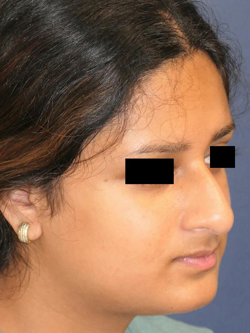 Rhinoplasty Before & After Gallery - Patient 890061 - Image 3