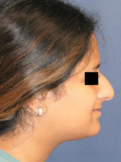 Rhinoplasty Before & After Gallery - Patient 890061 - Image 1