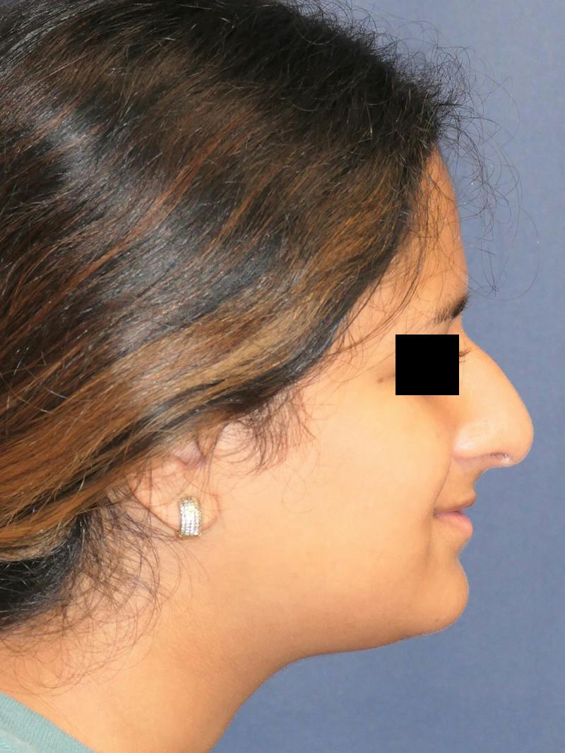 Rhinoplasty Before & After Gallery - Patient 890061 - Image 1