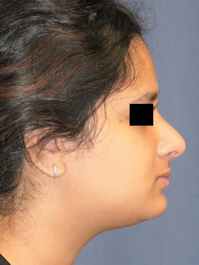 Rhinoplasty Before & After Gallery - Patient 890061 - Image 2