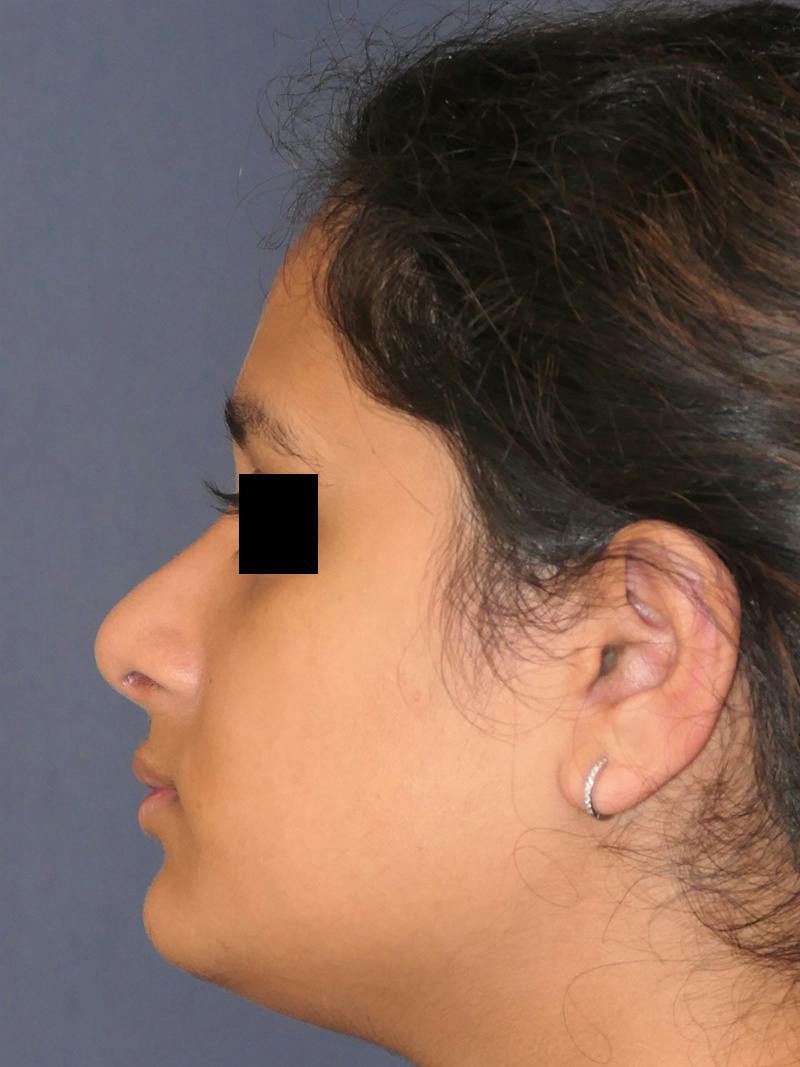 Rhinoplasty Before & After Gallery - Patient 890061 - Image 10