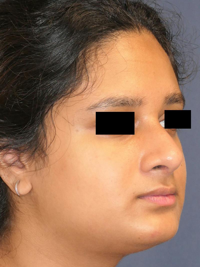 Rhinoplasty Before & After Gallery - Patient 890061 - Image 4