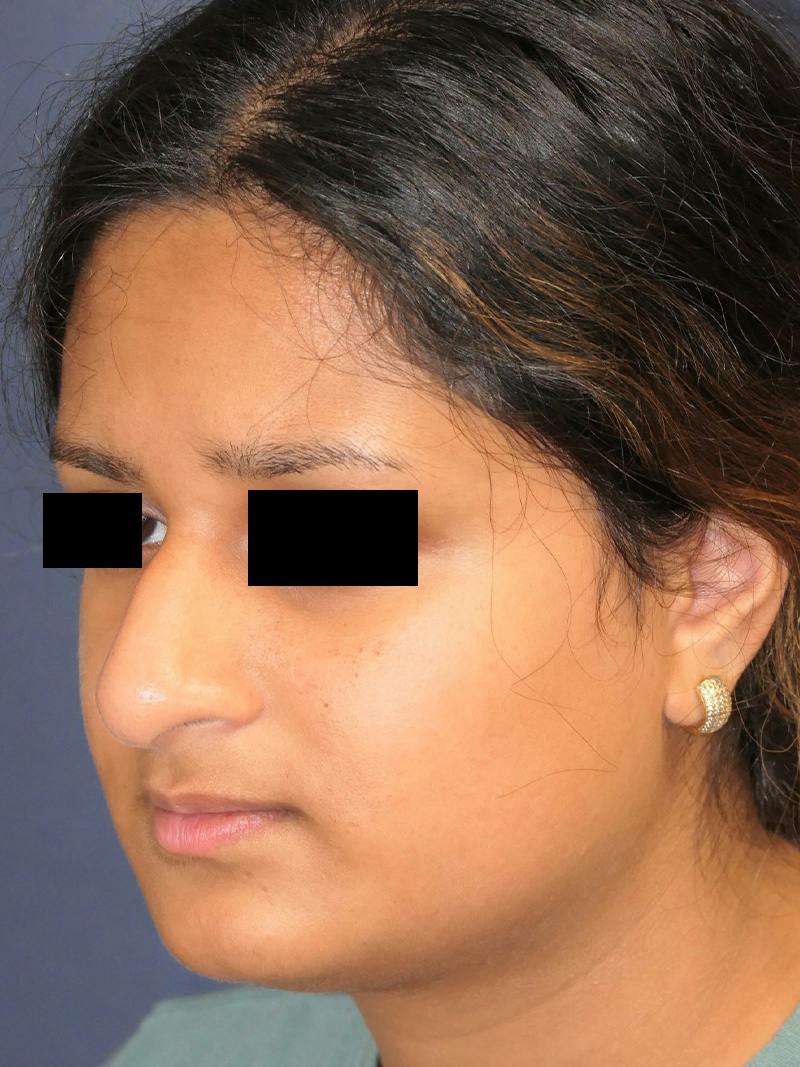 Rhinoplasty Before & After Gallery - Patient 890061 - Image 7