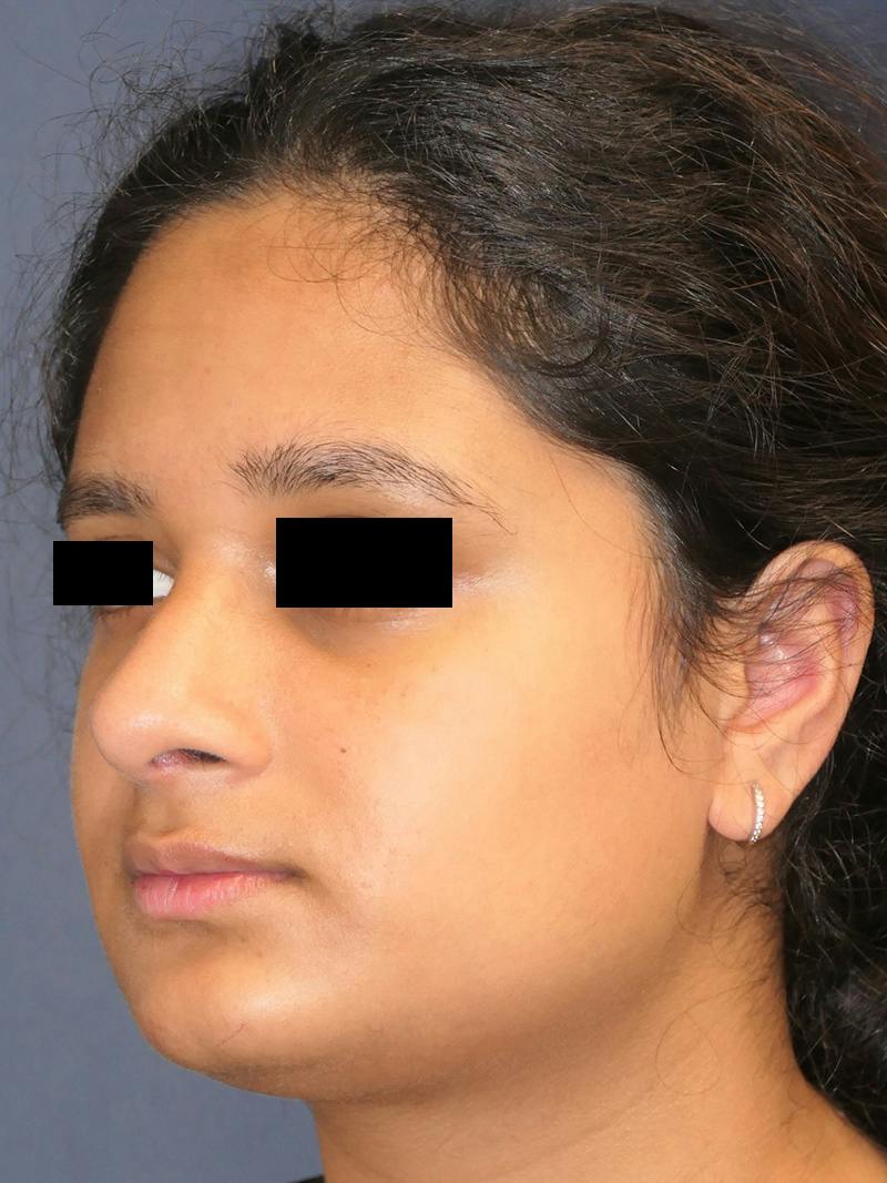 Rhinoplasty Before & After Gallery - Patient 890061 - Image 8