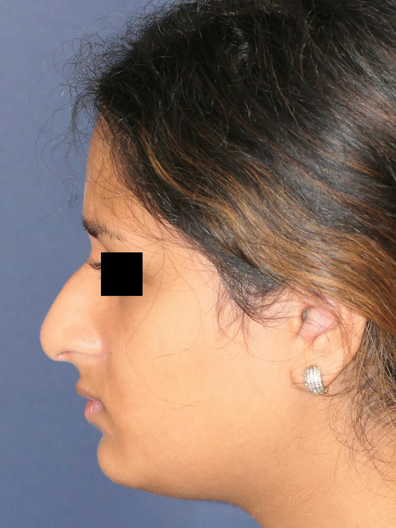 Rhinoplasty Before & After Gallery - Patient 890061 - Image 9