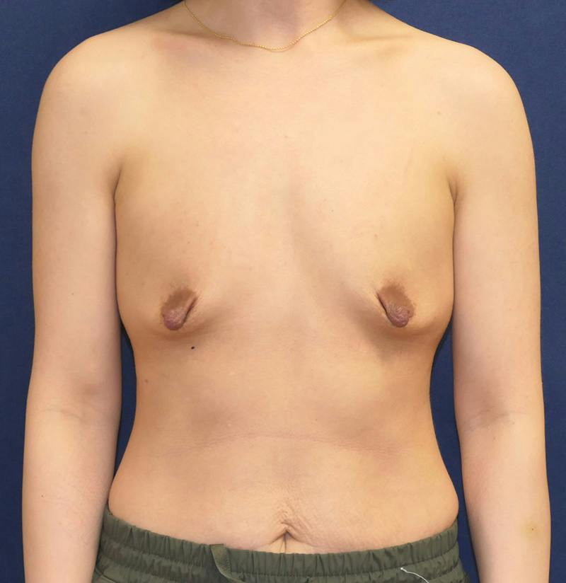 Breast Reconstruction with Implants Only Before & After Gallery - Patient 451244 - Image 1