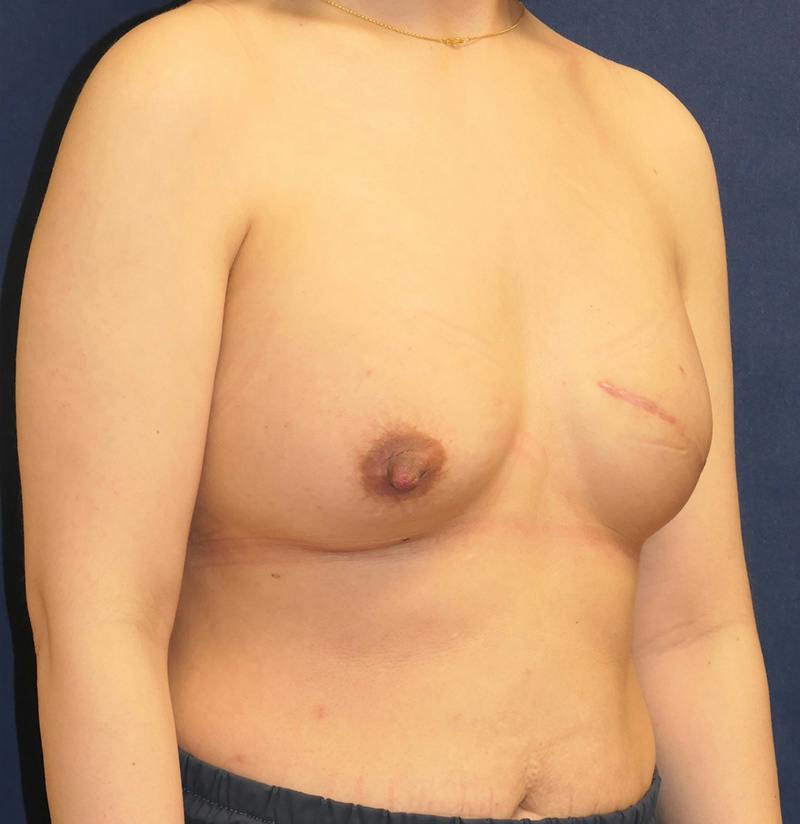 Breast Reconstruction with Implants Only Before & After Gallery - Patient 451244 - Image 4