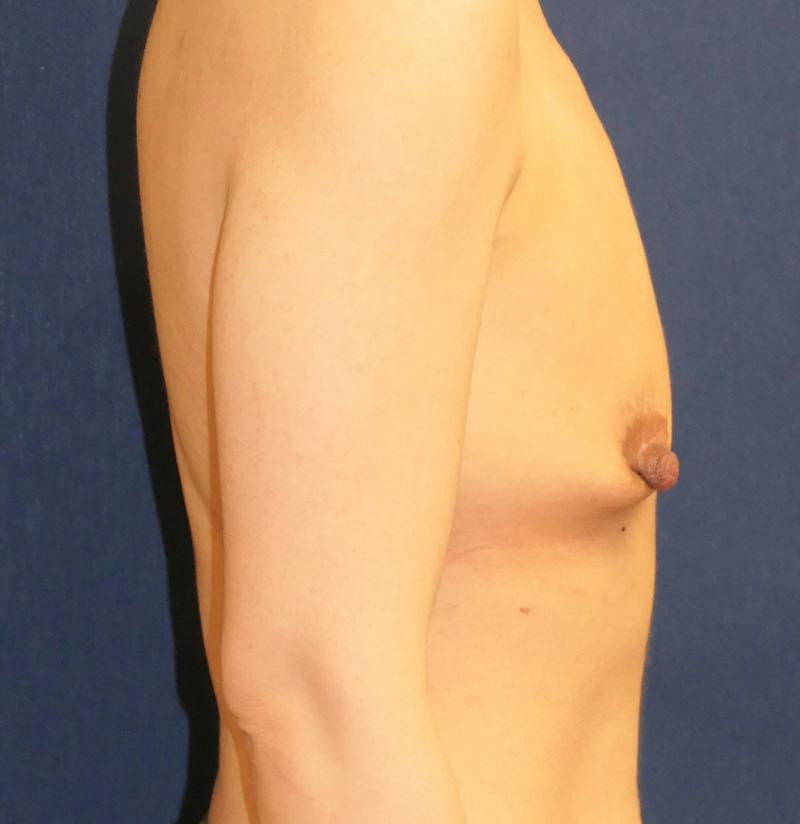 Breast Reconstruction with Implants Only Before & After Gallery - Patient 451244 - Image 5