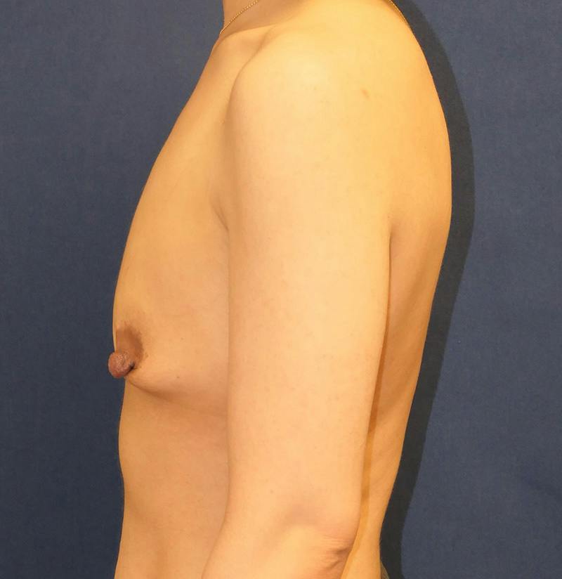 Breast Reconstruction with Implants Only Before & After Gallery - Patient 451244 - Image 9