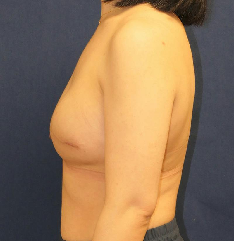 Breast Reconstruction with Implants Only Before & After Gallery - Patient 451244 - Image 10