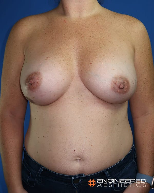 Breast Augmentation  Before & After Gallery - Patient 2772420 - Image 2
