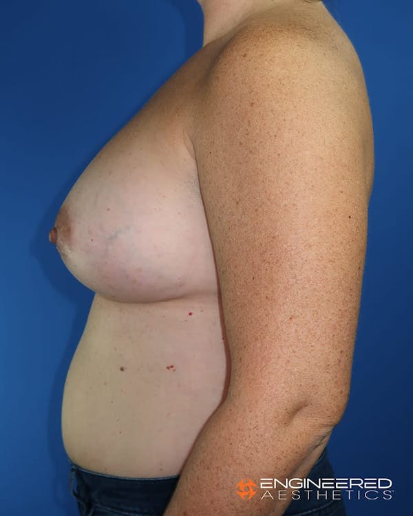 Breast Augmentation  Before & After Gallery - Patient 2772420 - Image 4
