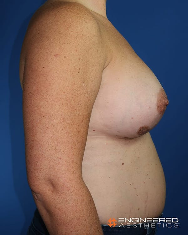 Breast Augmentation  Before & After Gallery - Patient 2772420 - Image 10
