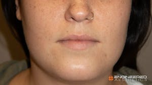Before and After facial fillers in Las Vegas