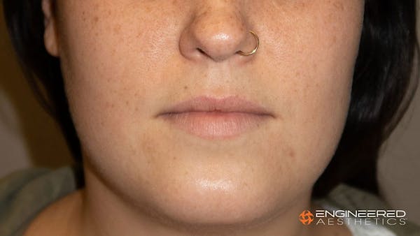 Fillers Before & After Gallery - Patient 2769965 - Image 1