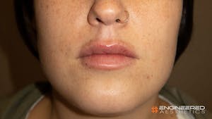 Before and After facial fillers in Las Vegas