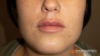 Fillers Before & After Gallery - Patient 2769965 - Image 2