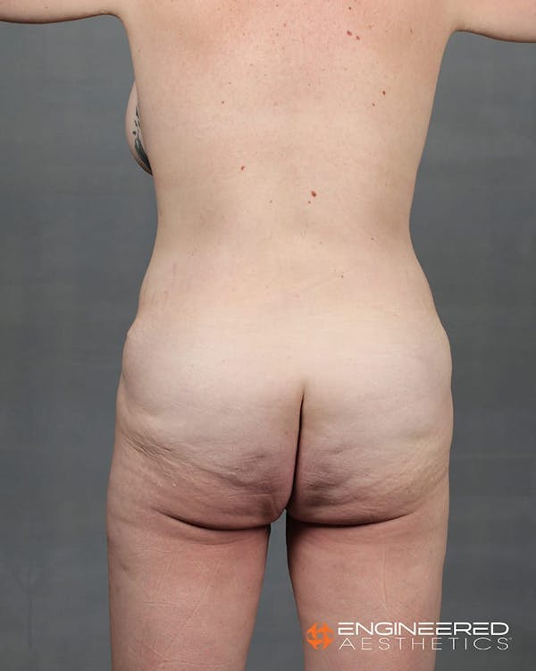 Gluteal Lift Before & After Gallery - Patient 2772491 - Image 5