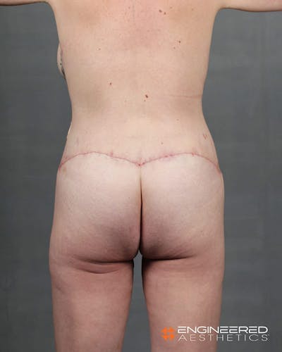 Gluteal Lift Before & After Gallery - Patient 2772491 - Image 6