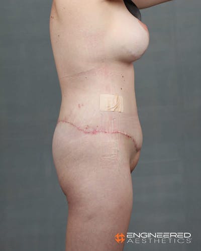 Gluteal Lift Before & After Gallery - Patient 2772491 - Image 8