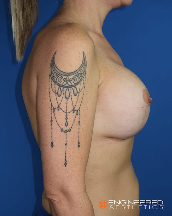 Mastopexy Augmentation Before & After Gallery - Patient 2772561 - Image 10