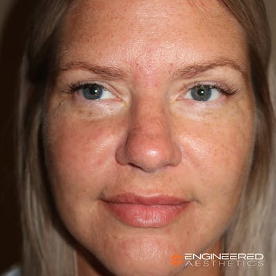 Rhinoplasty Before & After Gallery - Patient 4545370 - Image 1