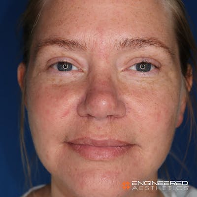 Rhinoplasty Before & After Gallery - Patient 4545370 - Image 2