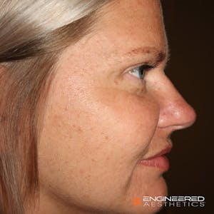 Rhinoplasty in Las Vegas Before and After photos