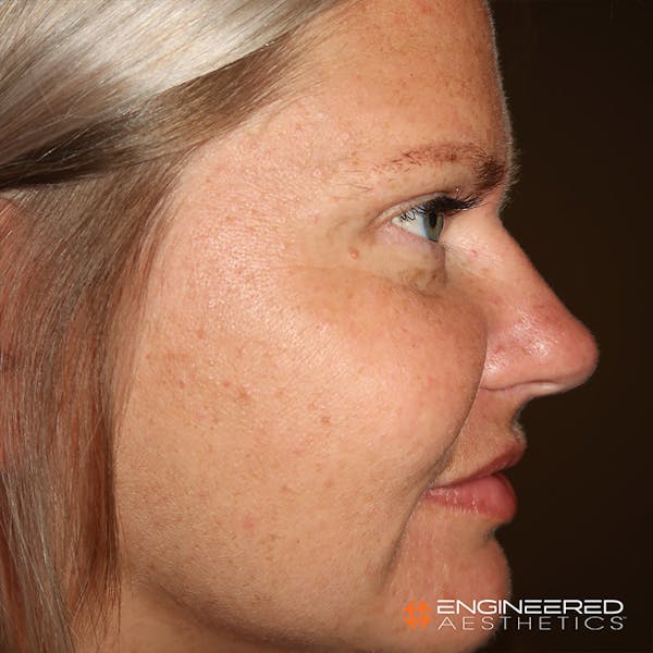 Rhinoplasty Before & After Gallery - Patient 4545370 - Image 3