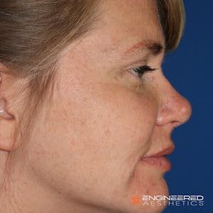 Before and After Las Vegas rhinoplasty