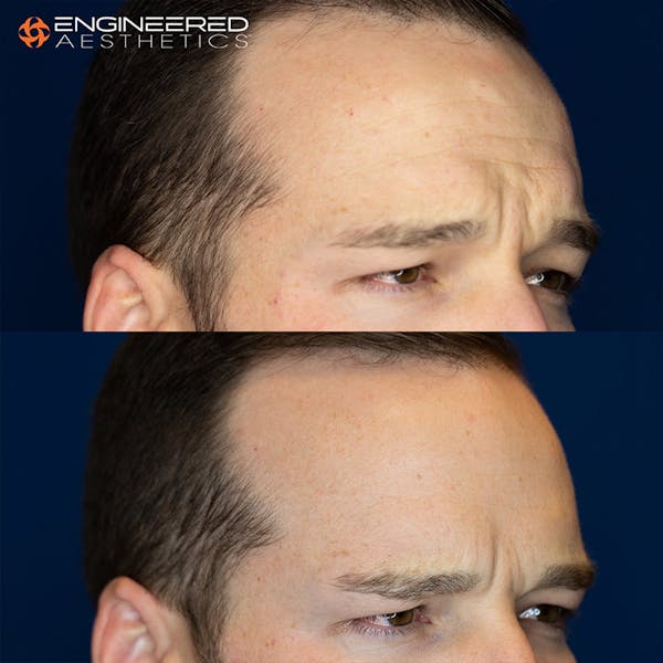 Botox Before & After Gallery - Patient 4545392 - Image 4
