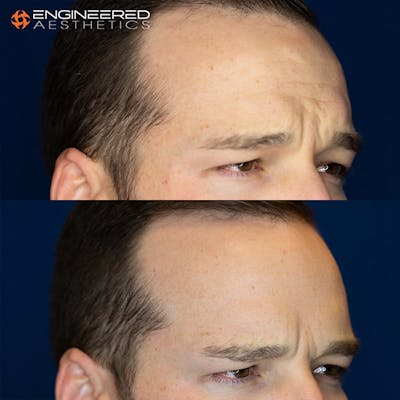 Botox Before & After Gallery - Patient 4545392 - Image 4