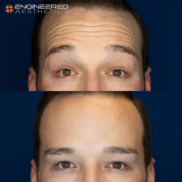 Botox Before & After Gallery - Patient 4545392 - Image 1