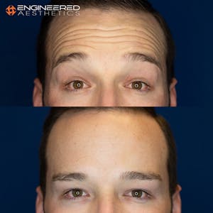 Botox in Las Vegas Before and After photos