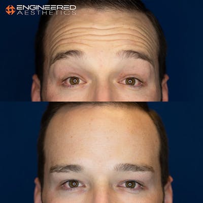 Botox Before & After Gallery - Patient 4545392 - Image 1