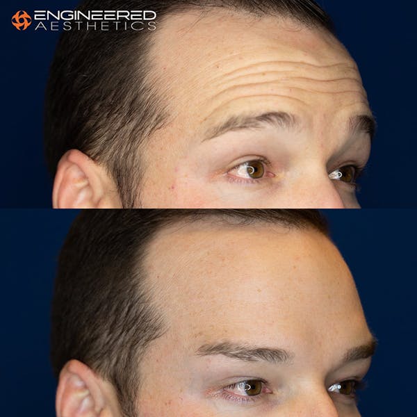 Botox Before & After Gallery - Patient 4545392 - Image 2