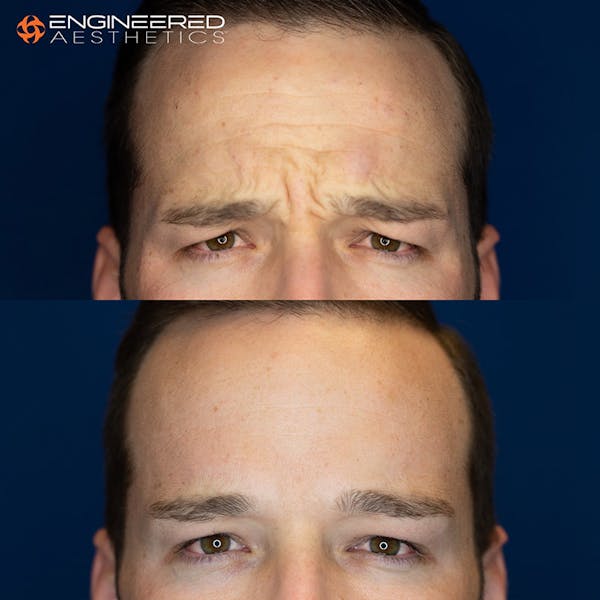Botox Before & After Gallery - Patient 4545392 - Image 3