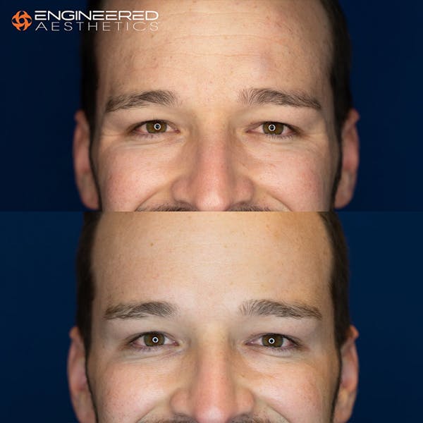 Botox Before & After Gallery - Patient 4545392 - Image 5