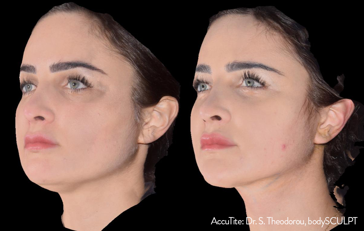  Before and After Accutite