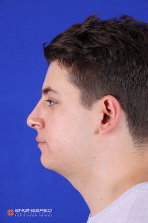 Before and After acne scar treatment in Las Vegas