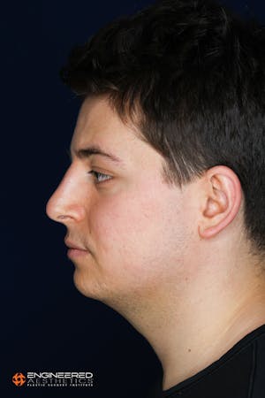 Before and After acne scar treatment in Las Vegas