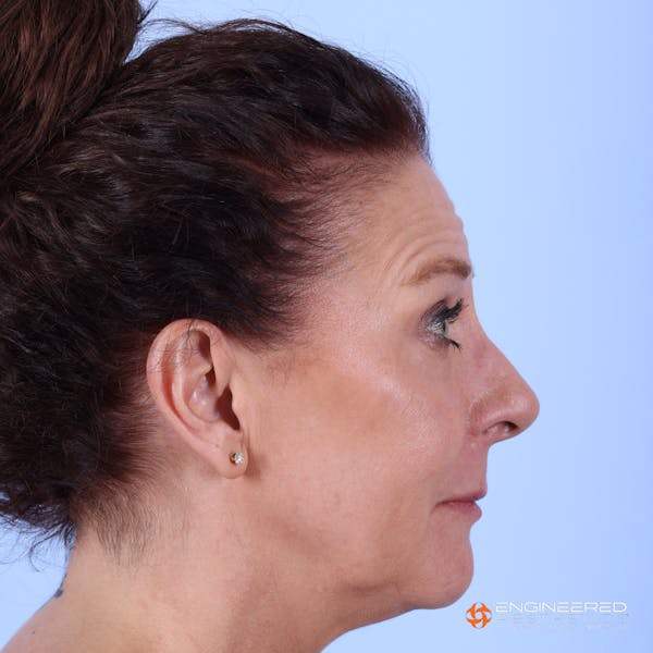 Fillers Before & After Gallery - Patient 147418449 - Image 3
